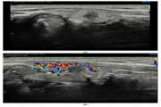 Diagnostic accuracy of sonoelastography in detecting malignant thyroid nodules: a systematic review and meta-analysis 